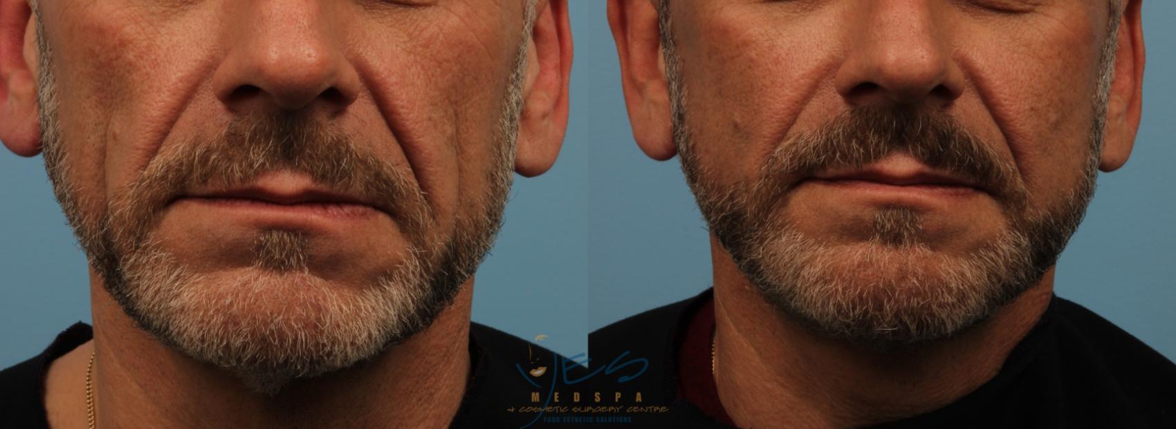 Before & After Face Lift & Neck Lift Case 232 View #1 View in Vancouver, BC