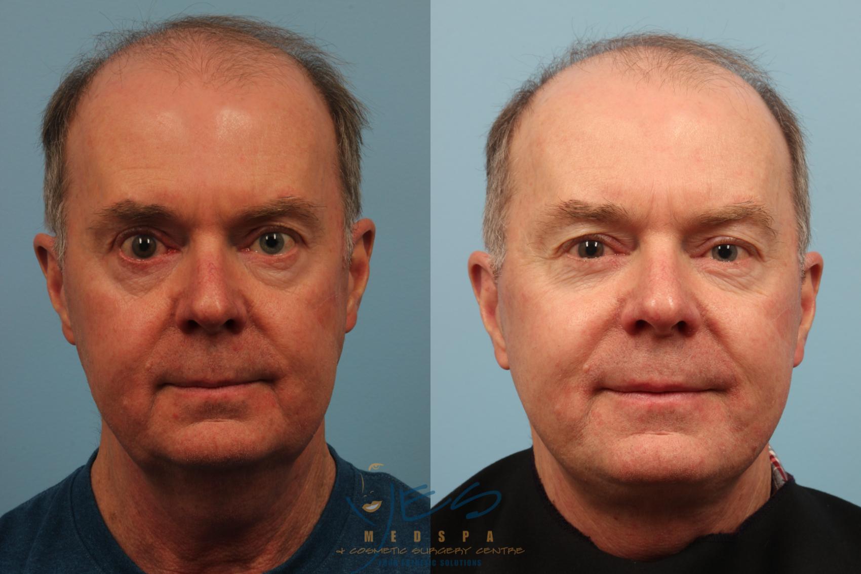 Before & After Face Lift & Neck Lift Case 296 Front View in Vancouver, BC
