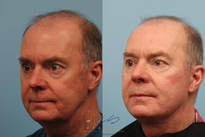 Before & After Face Lift & Neck Lift Case 296 Left Oblique View in Vancouver, BC