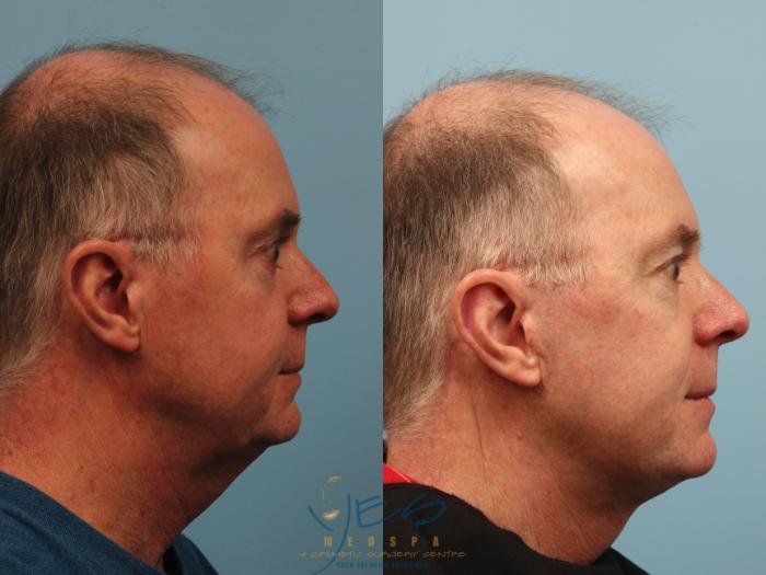 Before & After Face Lift & Neck Lift Case 296 Right Side View in Vancouver, BC