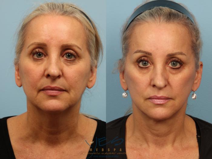 Before & After Face Lift & Neck Lift Case 394 Front View in Vancouver, BC