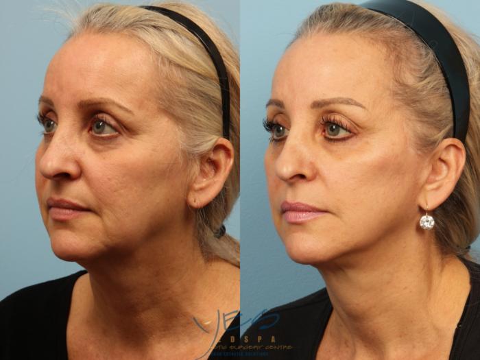 Before & After Face Lift & Neck Lift Case 394 Left Oblique View in Vancouver, BC