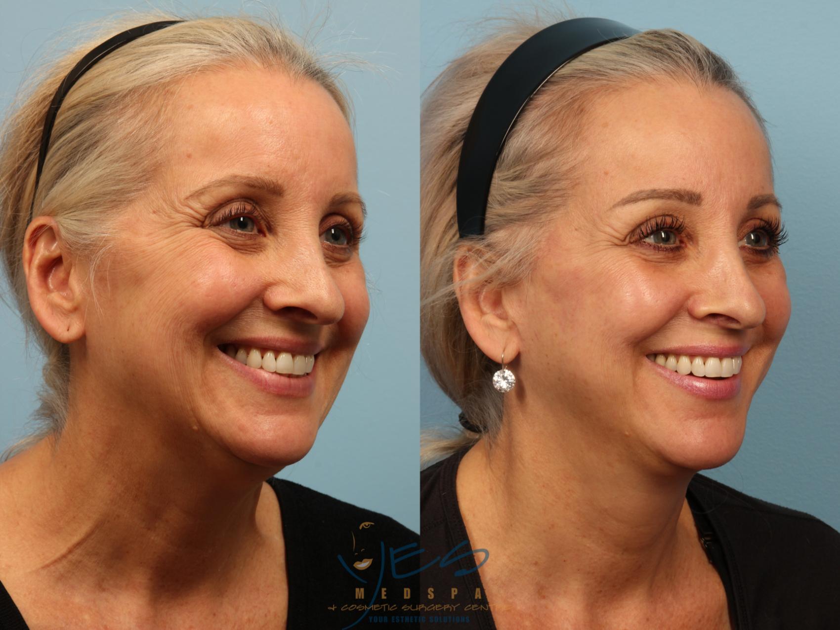 Face Lift & Neck Lift Before & After Photos Patient 394 Vancouver, BC