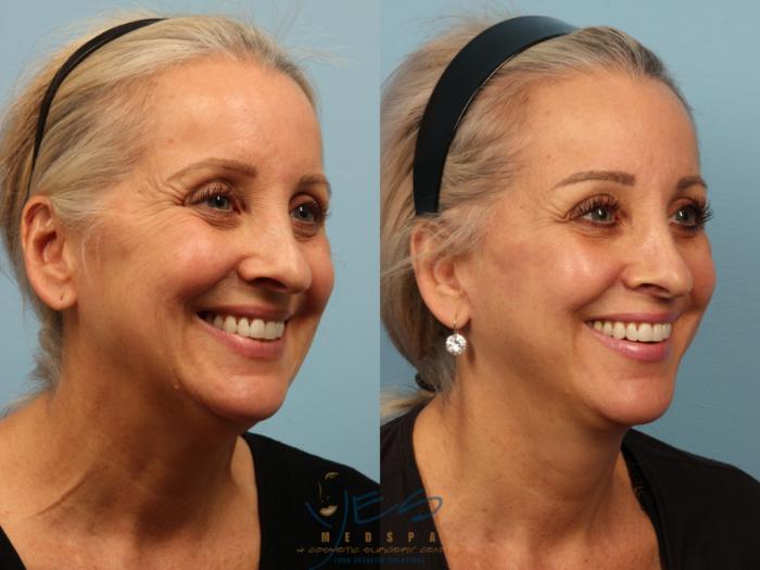 Before & After Face Lift & Neck Lift Case 394 Right Oblique View in Vancouver, BC