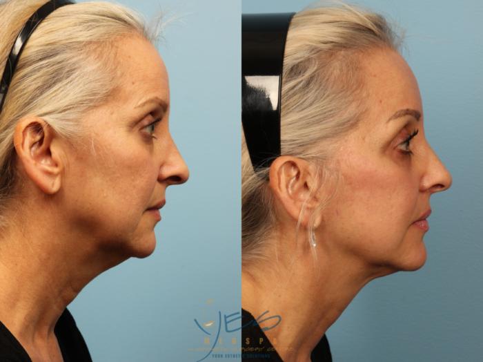 Before & After Face Lift & Neck Lift Case 394 Right Side View in Vancouver, BC