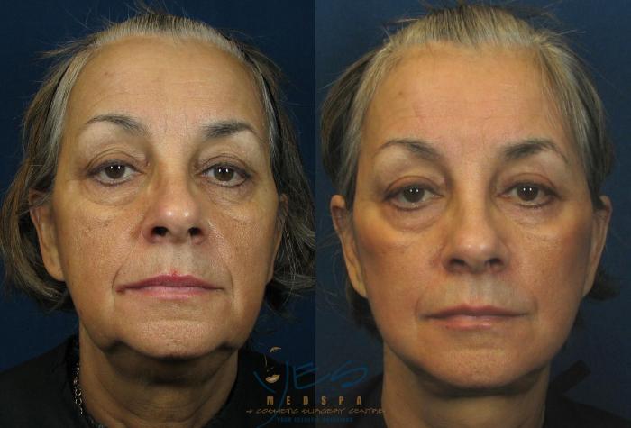 Before & After Face Lift & Neck Lift Case 46 View #1 View in Vancouver, BC