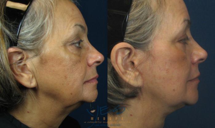 Before & After Face Lift & Neck Lift Case 46 View #2 View in Vancouver, BC
