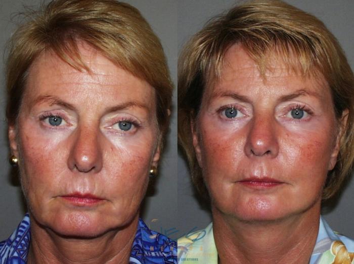Before & After Face Lift & Neck Lift Case 47 View #1 View in Vancouver, BC