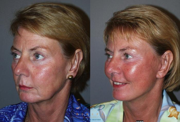 Before & After Face Lift & Neck Lift Case 47 View #2 View in Vancouver, BC