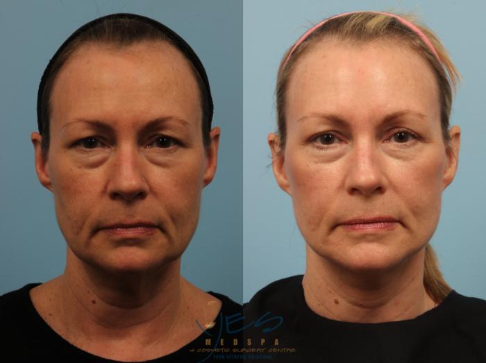 Before & After Upper & Lower Blepharoplasty Case 505 Front View in Vancouver, BC