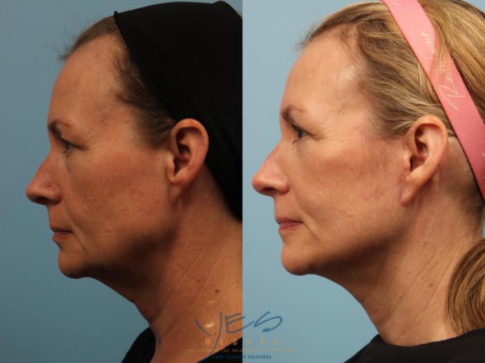Before & After Face Lift & Neck Lift Case 505 Left Side View in Vancouver, BC