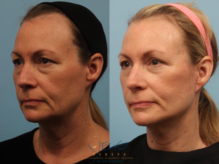 Before & After Face Lift & Neck Lift Case 505 Right Oblique View in Vancouver, BC