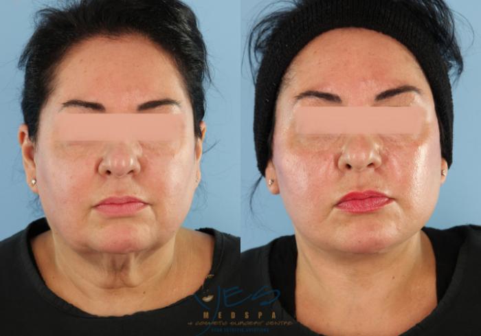 Before & After Face Lift & Neck Lift Case 582 Front View in Vancouver, BC