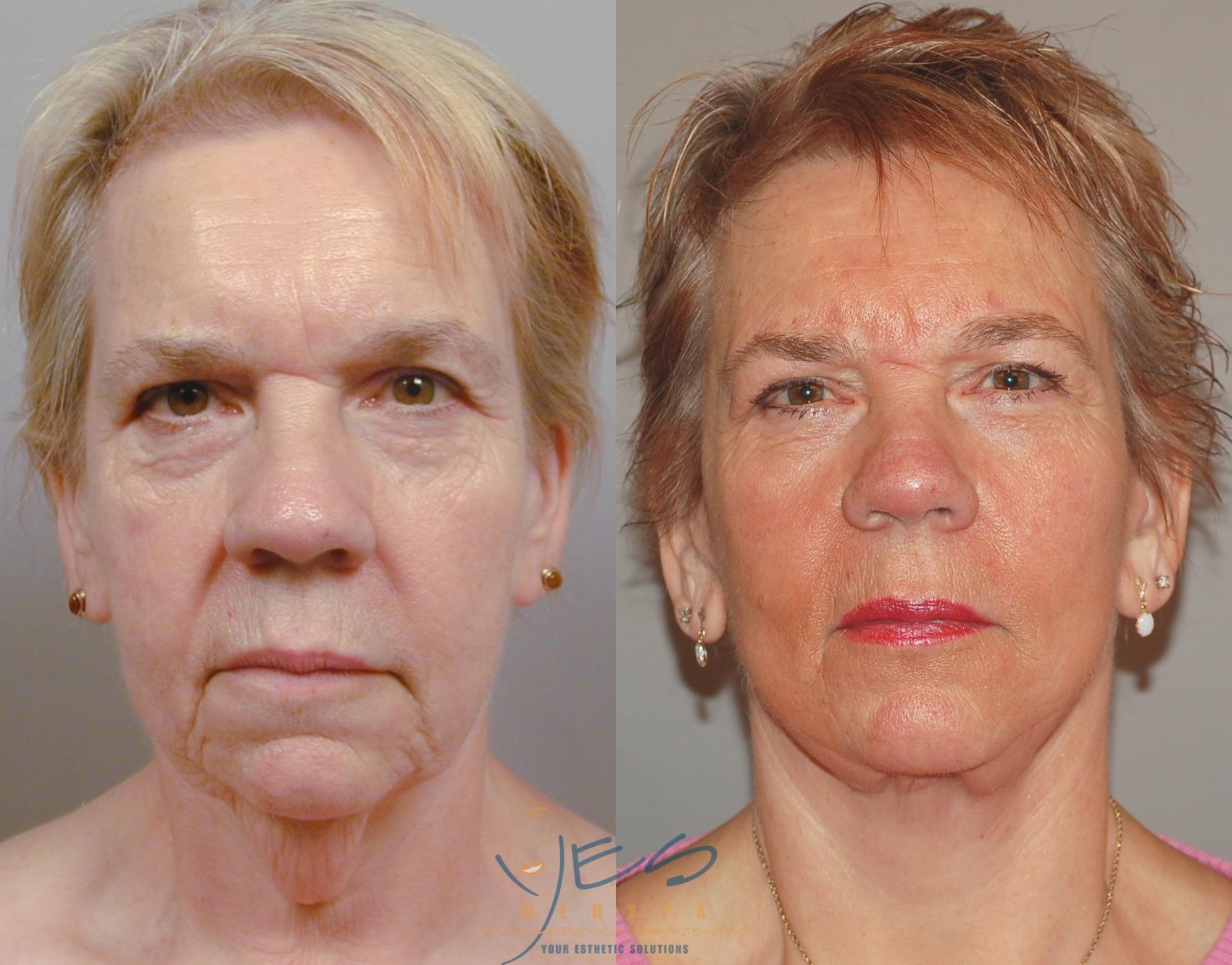 Before & After Face Lift & Neck Lift Case 91 View #1 View in Vancouver, BC
