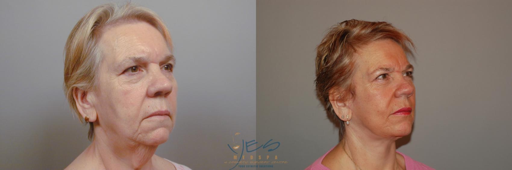 Before & After Face Lift & Neck Lift Case 91 View #2 View in Vancouver, BC
