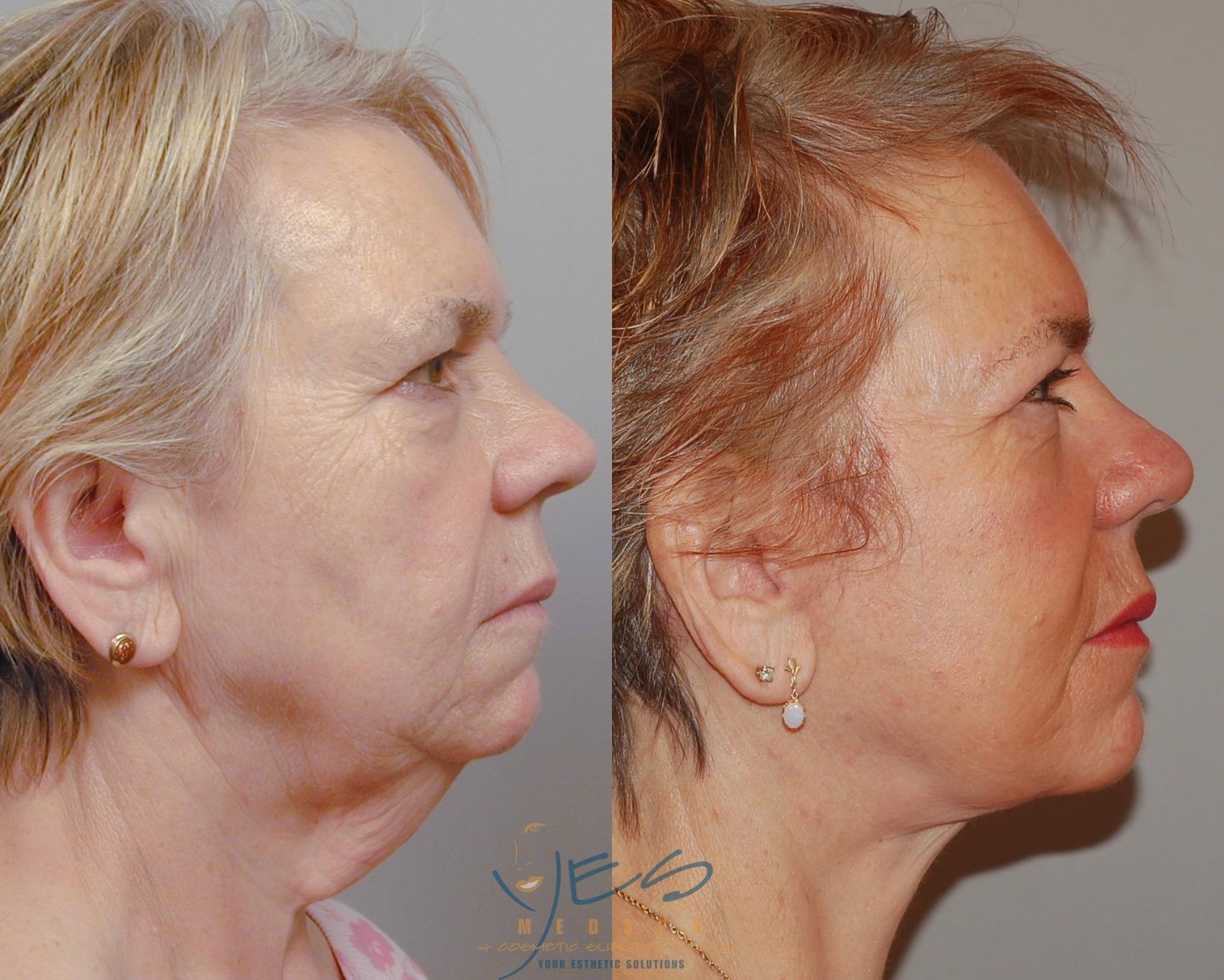 Before & After Face Lift & Neck Lift Case 91 View #3 View in Vancouver, BC