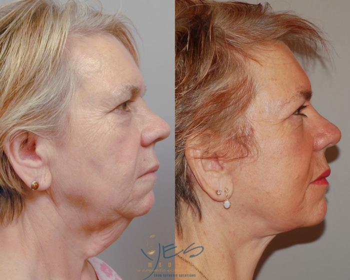 Before & After Face Lift & Neck Lift Case 91 View #3 View in Vancouver, BC
