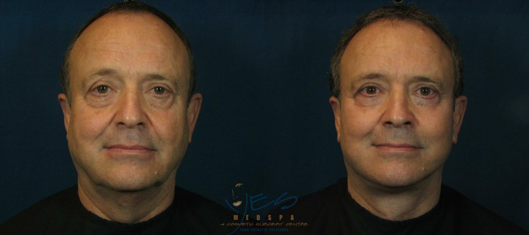 Before & After Face Lift & Neck Lift Case 93 View #1 View in Vancouver, BC