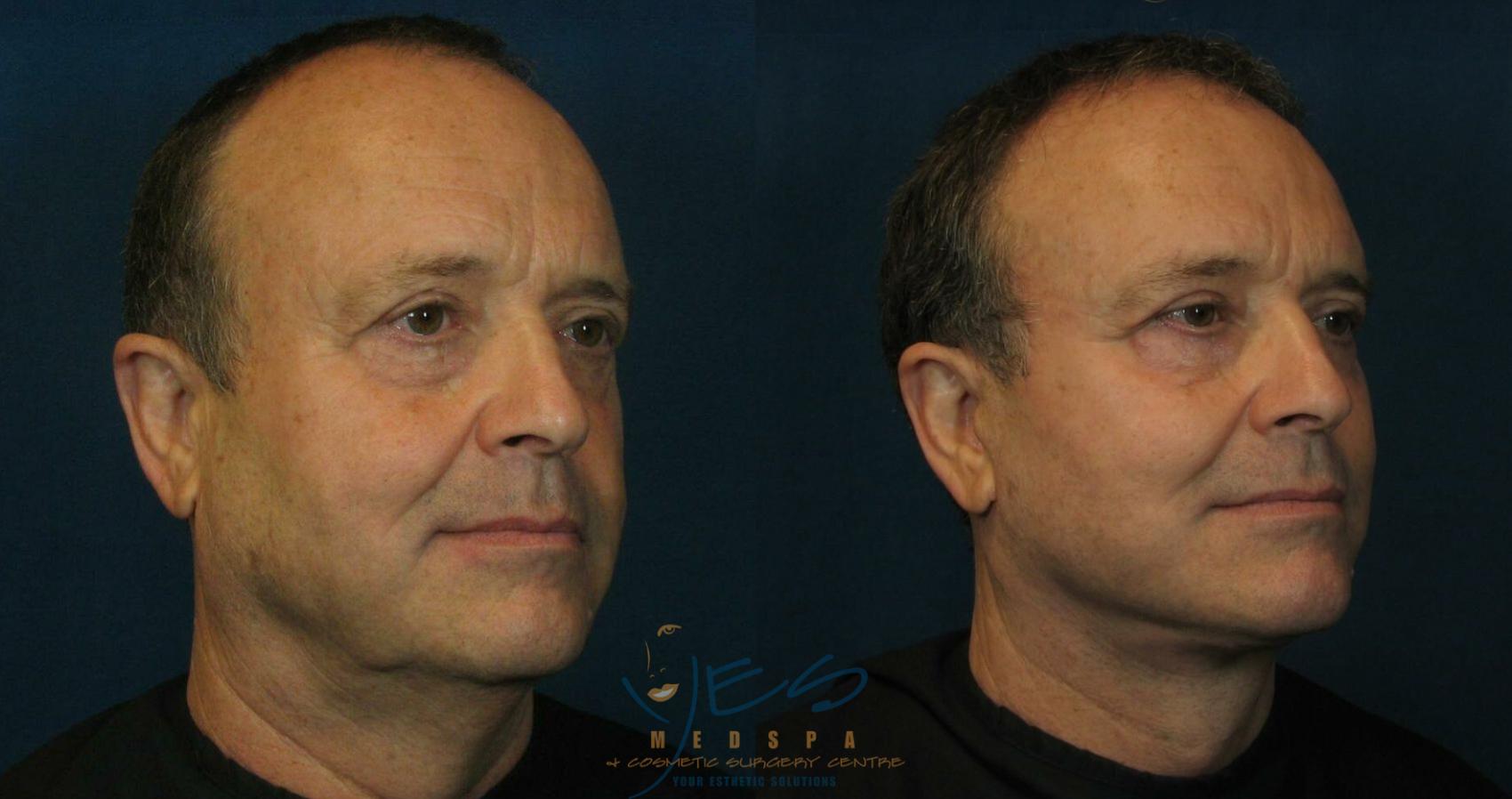 Before & After Face Lift & Neck Lift Case 93 View #2 View in Vancouver, BC
