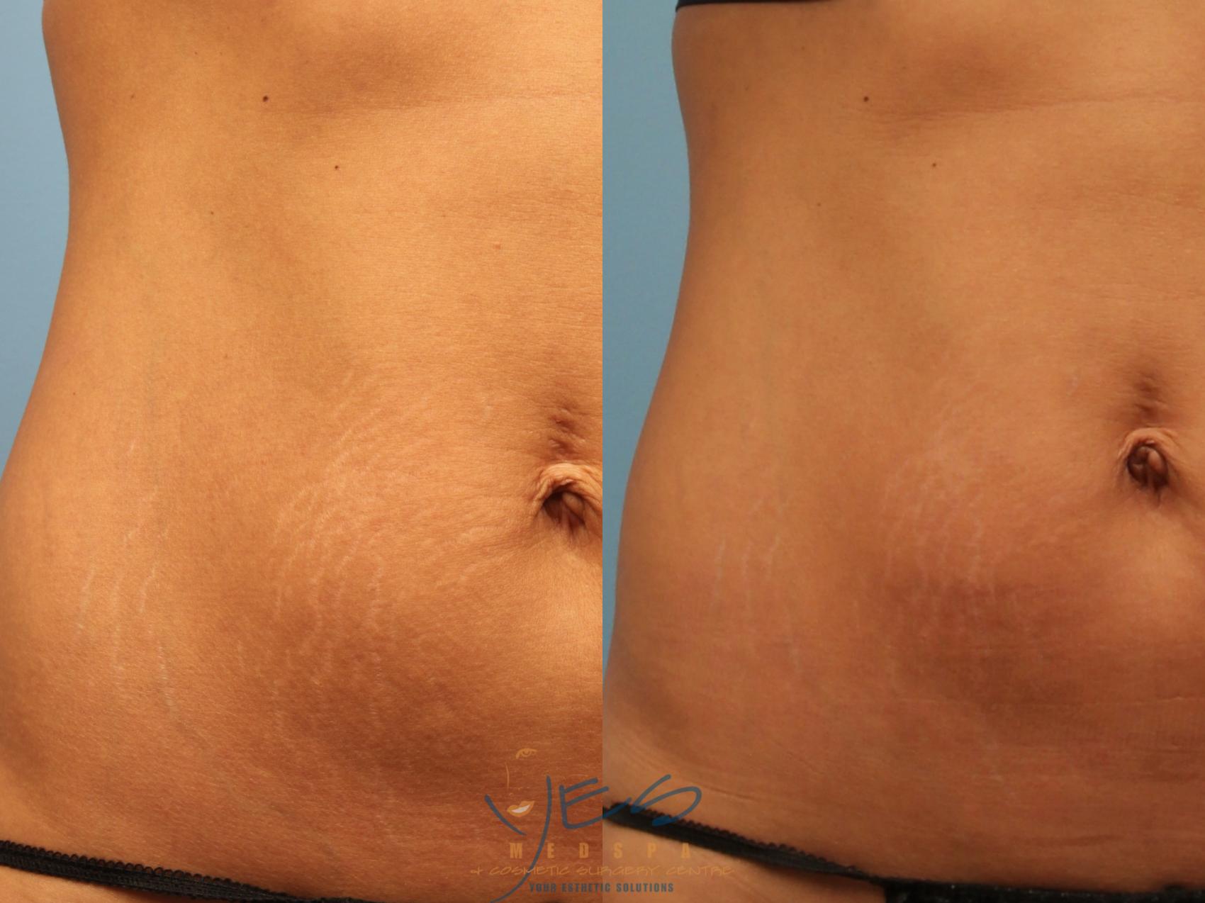 Before & After Laser Non-Ablative Fractional Resurfacing Case 262 Front View in Vancouver, BC