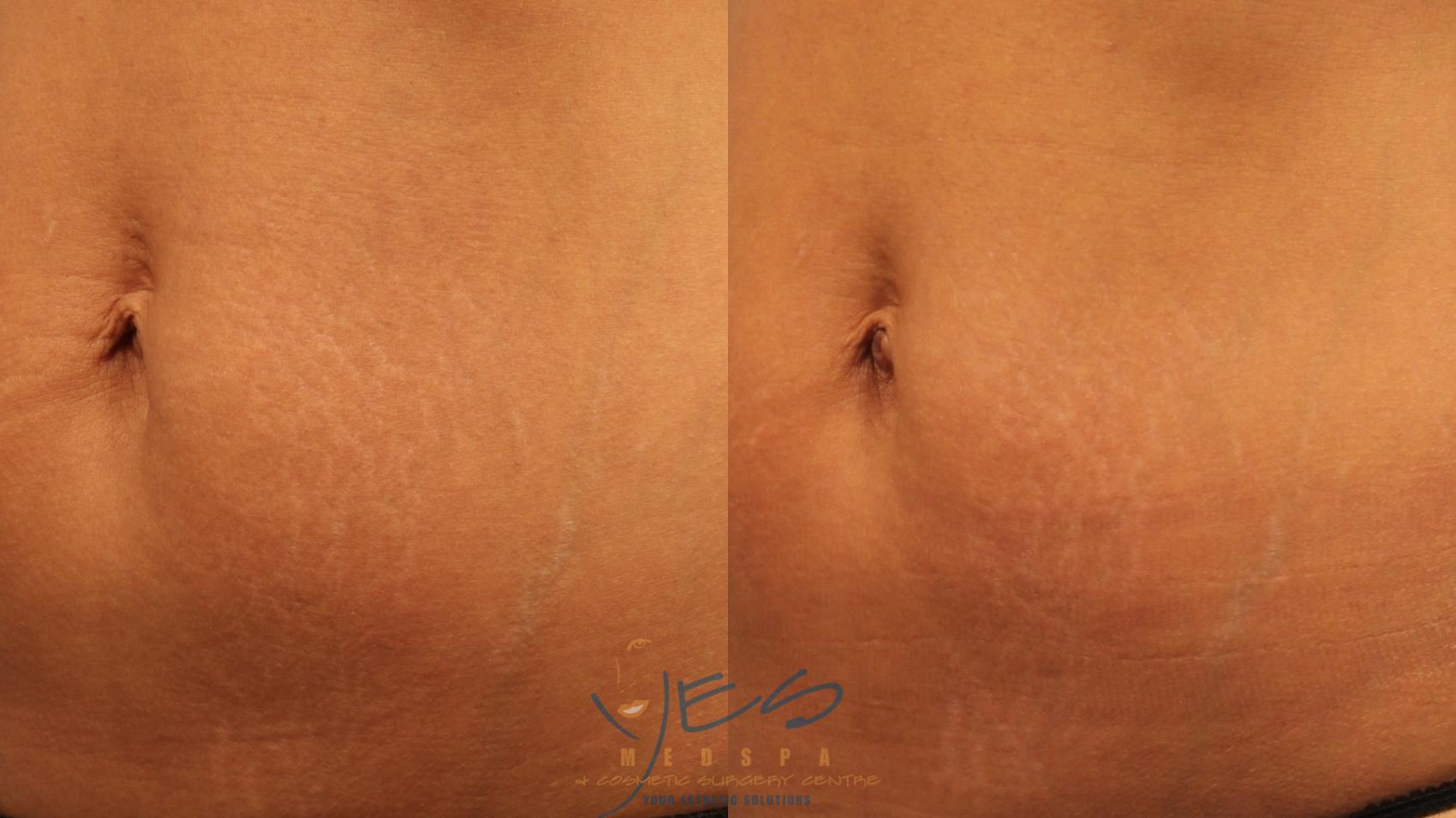 Before & After Laser Non-Ablative Fractional Resurfacing Case 262 Right Oblique View in Vancouver, BC