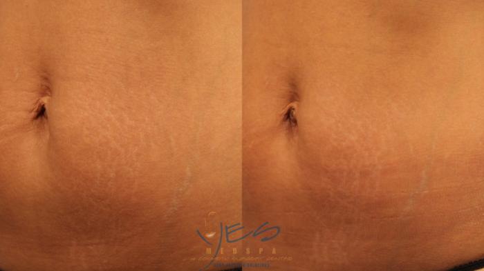 Before & After Laser Non-Ablative Fractional Resurfacing Case 262 Right Oblique View in Vancouver, BC