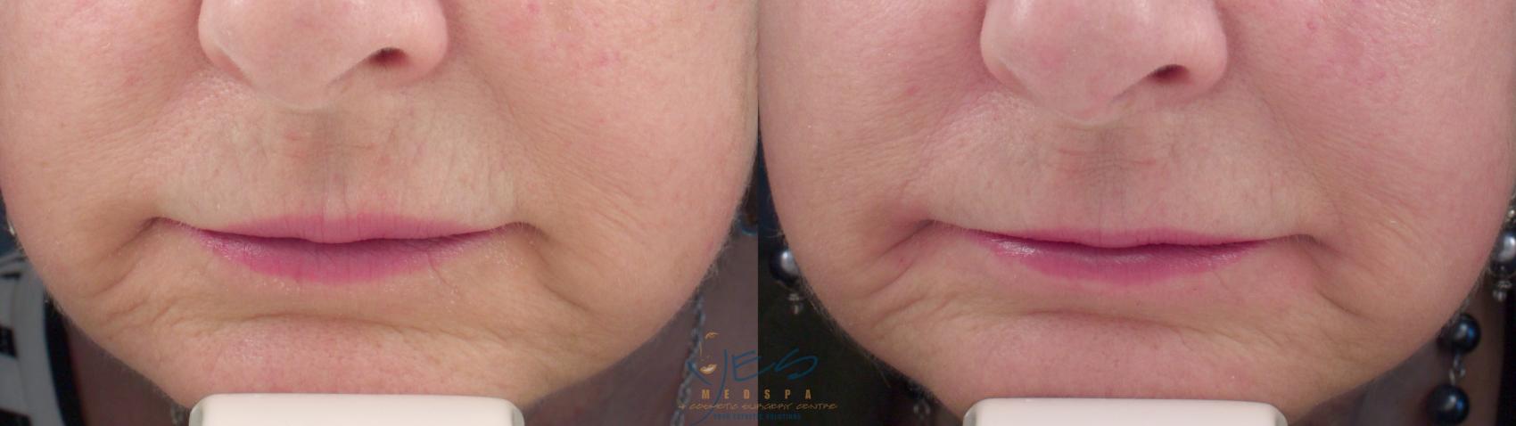Before & After Laser Non-Ablative Fractional Resurfacing Case 263 Front View in Vancouver, BC