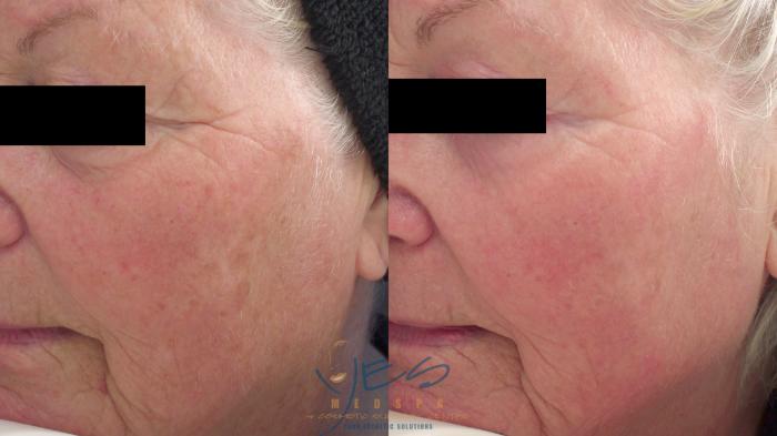 Before & After Laser Non-Ablative Fractional Resurfacing Case 264 Left Side View in Vancouver, BC