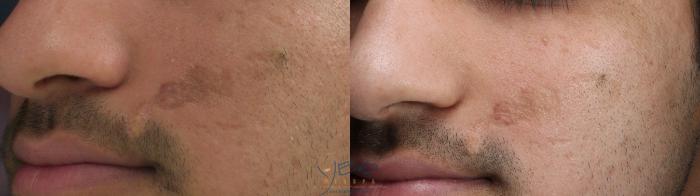 Before & After Laser Non-Ablative Fractional Resurfacing Case 329 Left Side View in Vancouver, BC