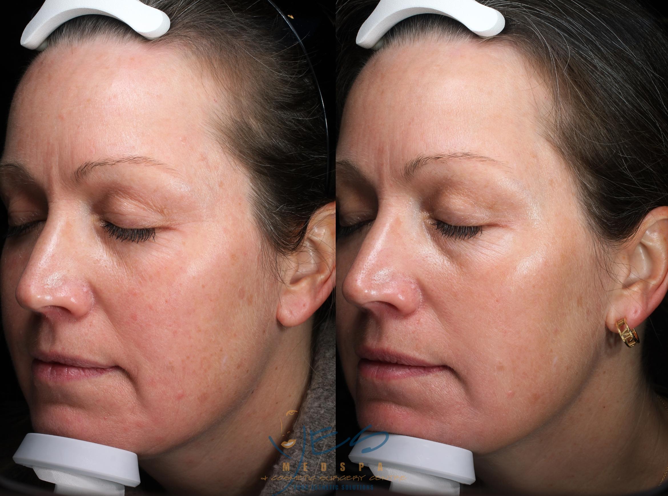 Before & After Laser Non-Ablative Fractional Resurfacing Case 364 Left Side View in Vancouver, BC
