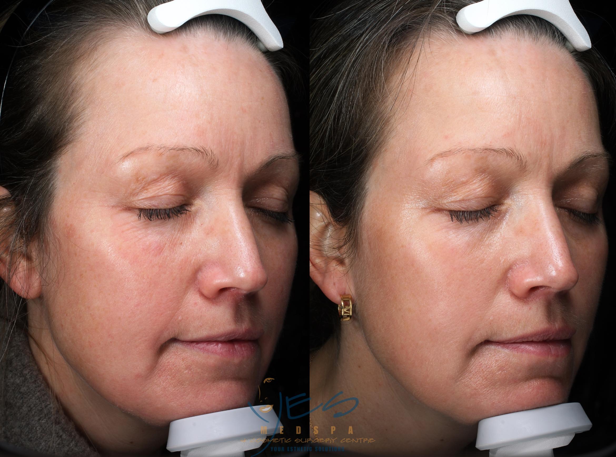 Before & After Laser Non-Ablative Fractional Resurfacing Case 364 Right Side View in Vancouver, BC