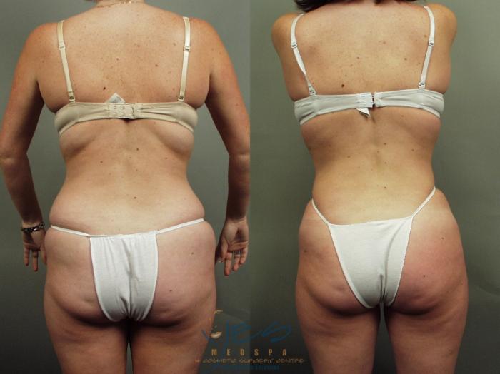 Before & After Liposuction Case 1 Back View in Vancouver, BC