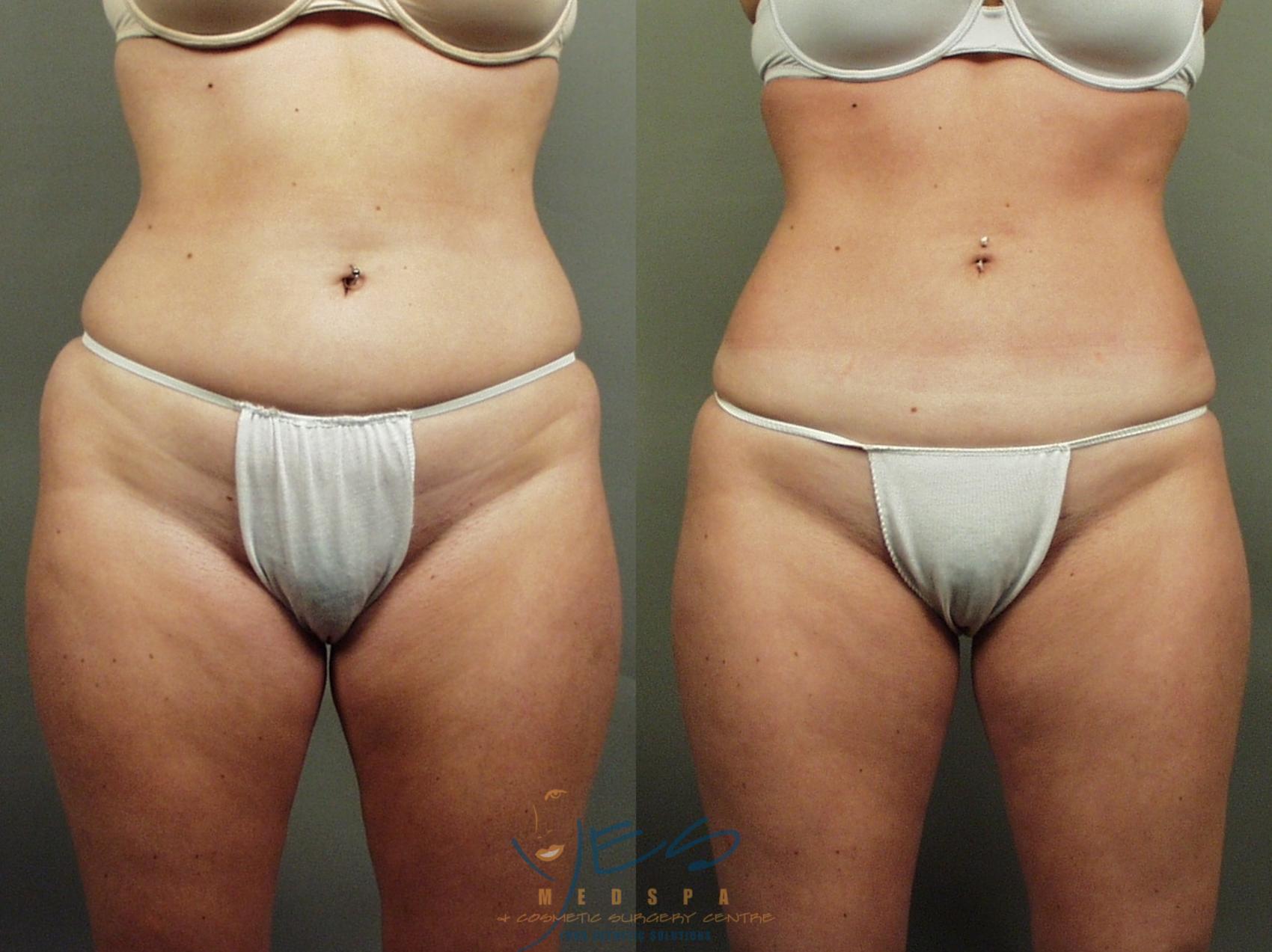 Before & After Liposuction Case 1 Front View in Vancouver, BC