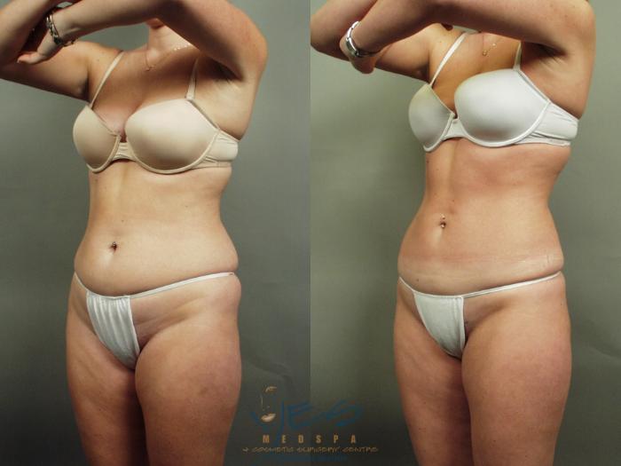 Before & After Liposuction Case 1 Left Oblique View in Vancouver, BC