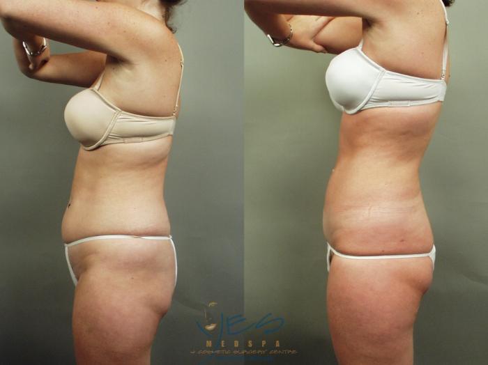 Before & After Liposuction Case 1 Left Side View in Vancouver, BC