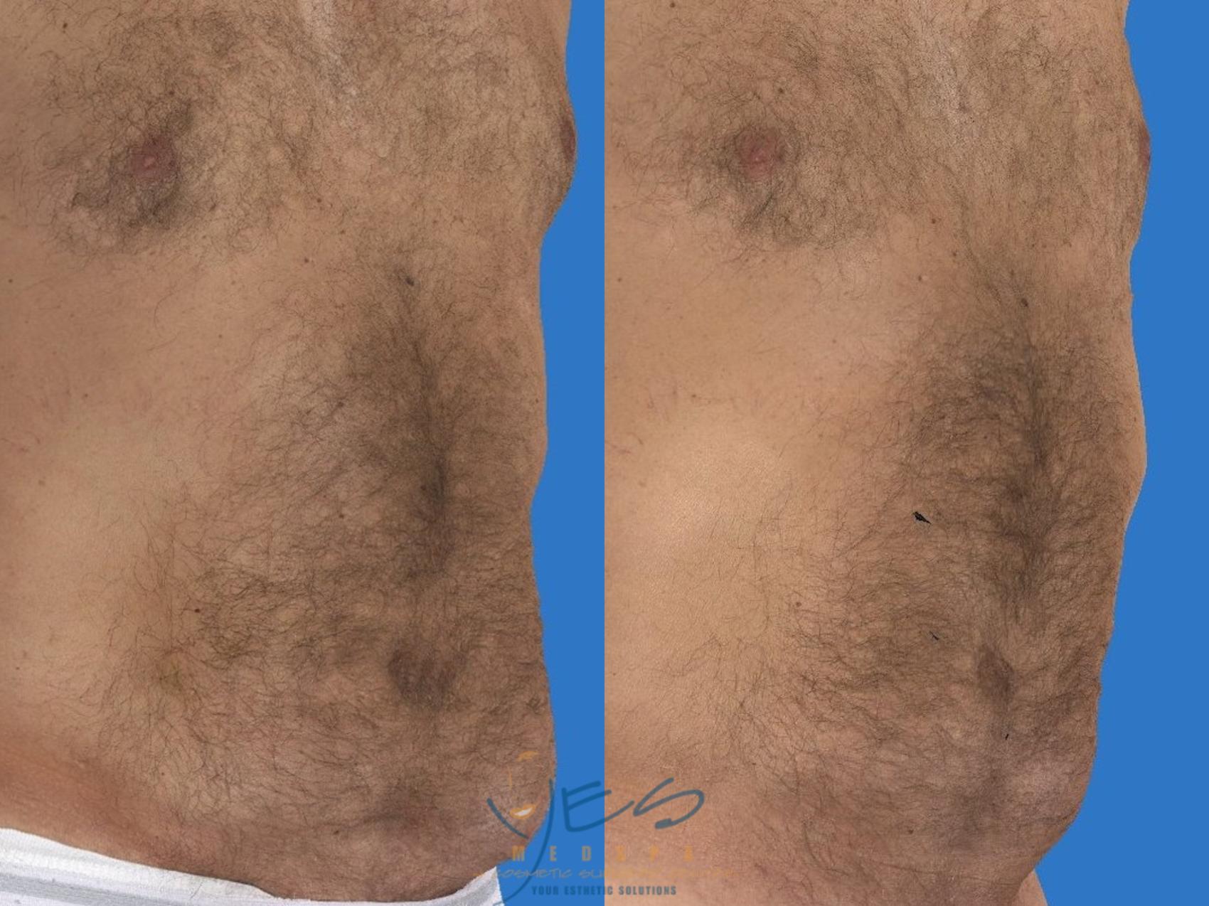 Before & After Liposuction Case 113 Right Oblique View in Vancouver, BC
