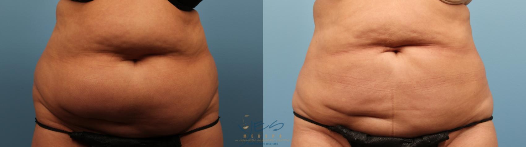 Before & After Liposuction Case 139 Front View in Vancouver, BC