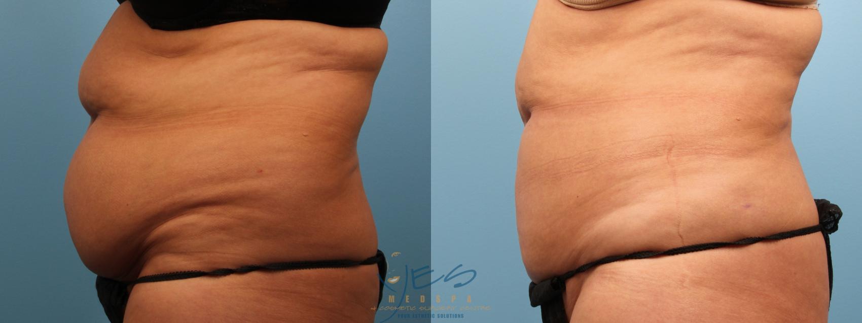 Before & After Liposuction Case 139 Left Side View in Vancouver, BC