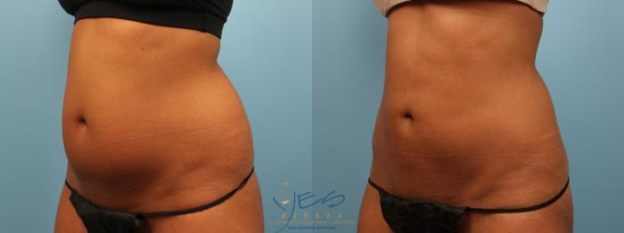 Before & After Liposuction Case 158 View #2 View in Vancouver, BC