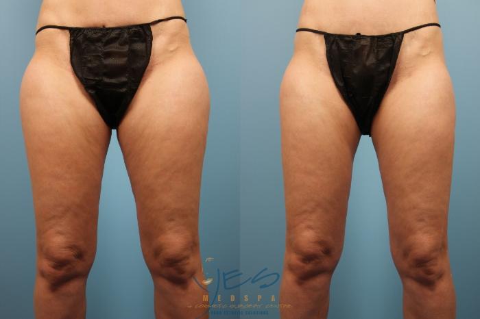 Before & After SmartLipo™ Case 162 Front View in Vancouver, BC