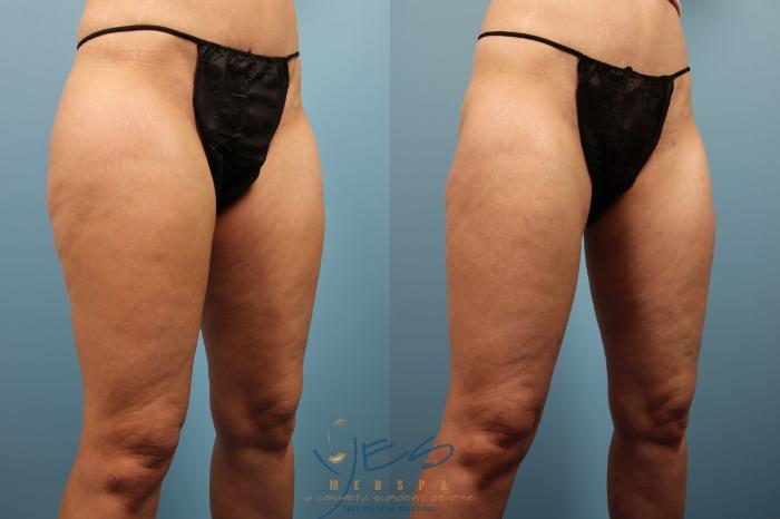 Before & After Liposuction Case 162 Right Oblique View in Vancouver, BC