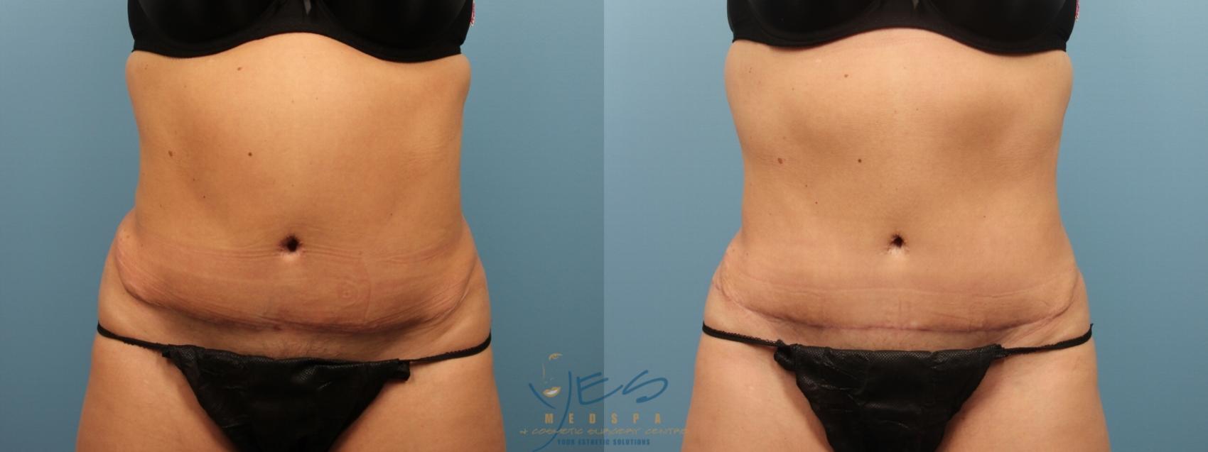 Does a Tummy Tuck Make Your Waist Smaller? (Before and After