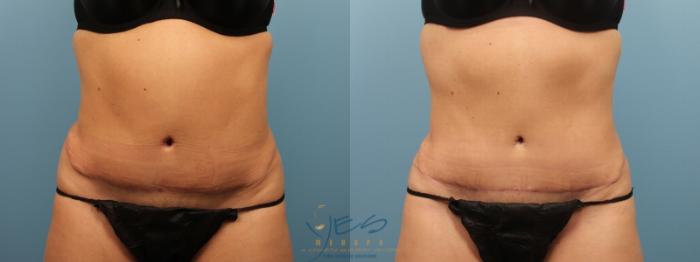 Before & After Liposuction Case 163 Front View in Vancouver, BC