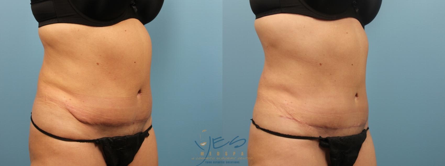 Before & After Liposuction Case 163 Right Oblique View in Vancouver, BC