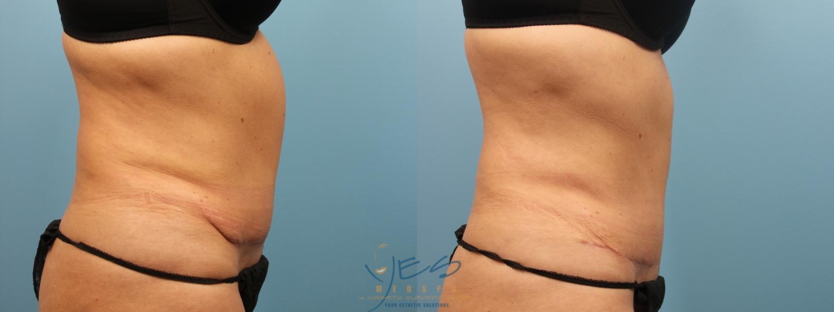 Before & After Liposuction Case 163 Right Side View in Vancouver, BC