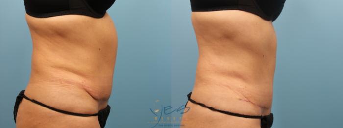Before & After SmartLipo™ Case 163 Right Side View in Vancouver, BC
