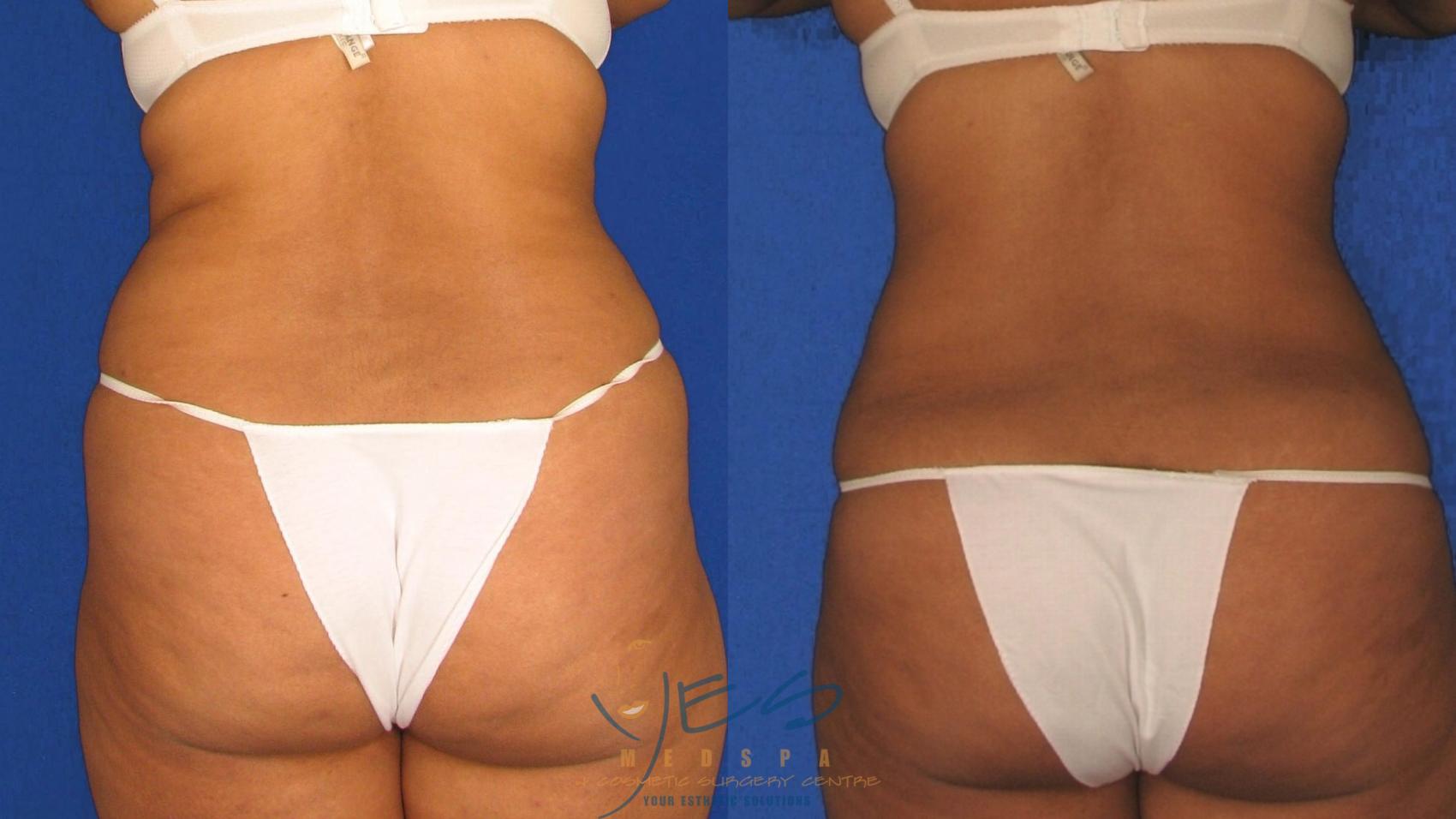 Before & After Liposuction Case 17 Back View in Vancouver, BC