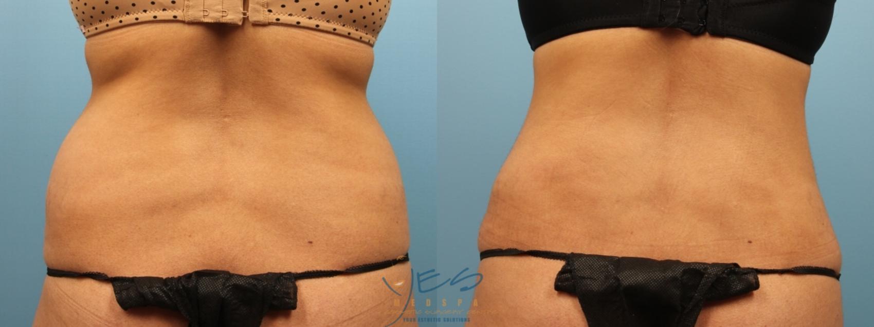 Before & After Liposuction Case 176 View #3 View in Vancouver, BC