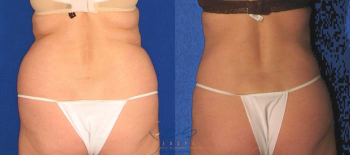 Before & After Liposuction Case 18 Back View in Vancouver, BC