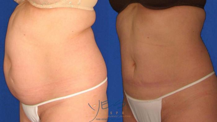 Before & After Liposuction Case 18 Left Oblique View in Vancouver, BC